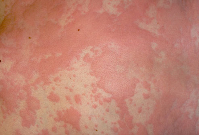 Vörös foltok a bőrön, okok, kezelés: Betegségek