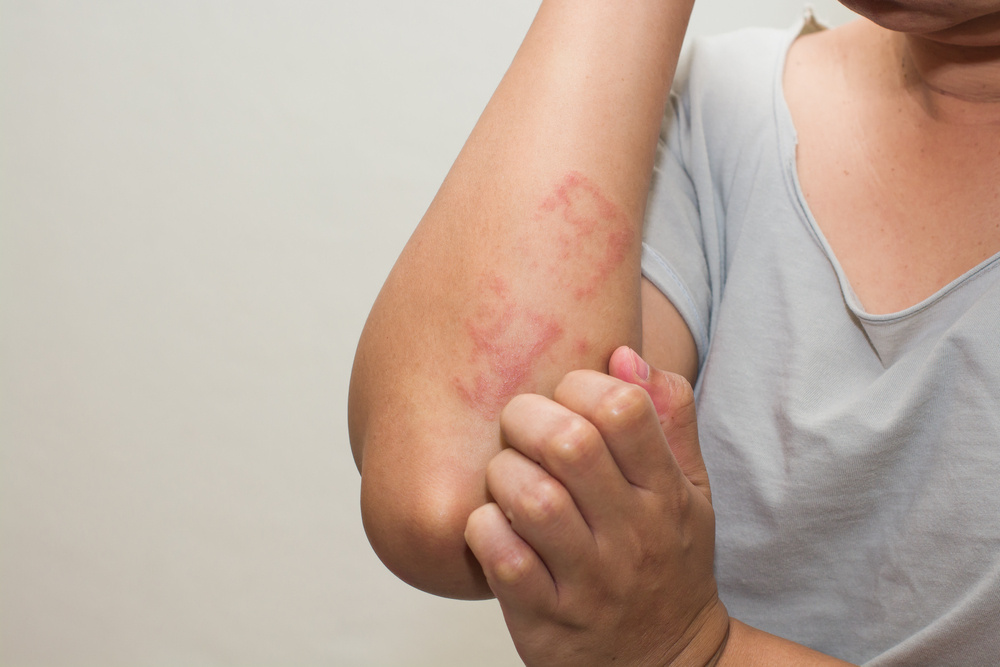 3 bőrbetegség, amit súlyosbít a stressz