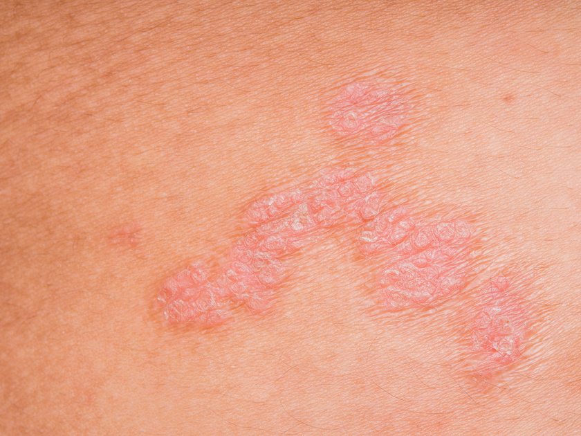 vörös foltok mérgezése a bőrön torsunov pikkelysömör kezelése