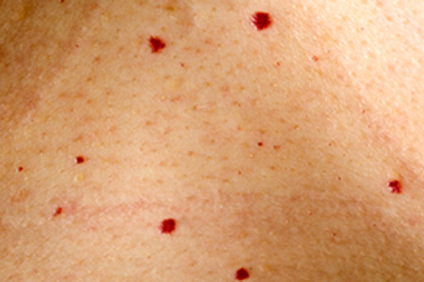 Atópiás dermatitisz tünetei és kezelése - HáziPatika