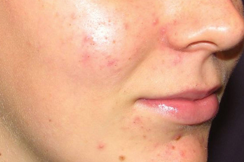 Milyen betegségre utalnak a vörös foltok? Pattanások az arcon és vörös foltok