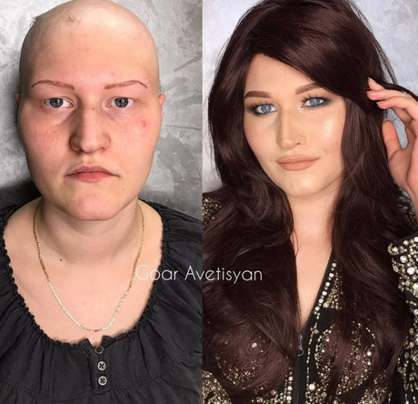 Anastasya kemoterápiás kezelést kap, amitől kihullott a haja, és a bőrét is megviselte. A profi smink és a paróka után elmondta, sokkal erősebbnek érezte magát.