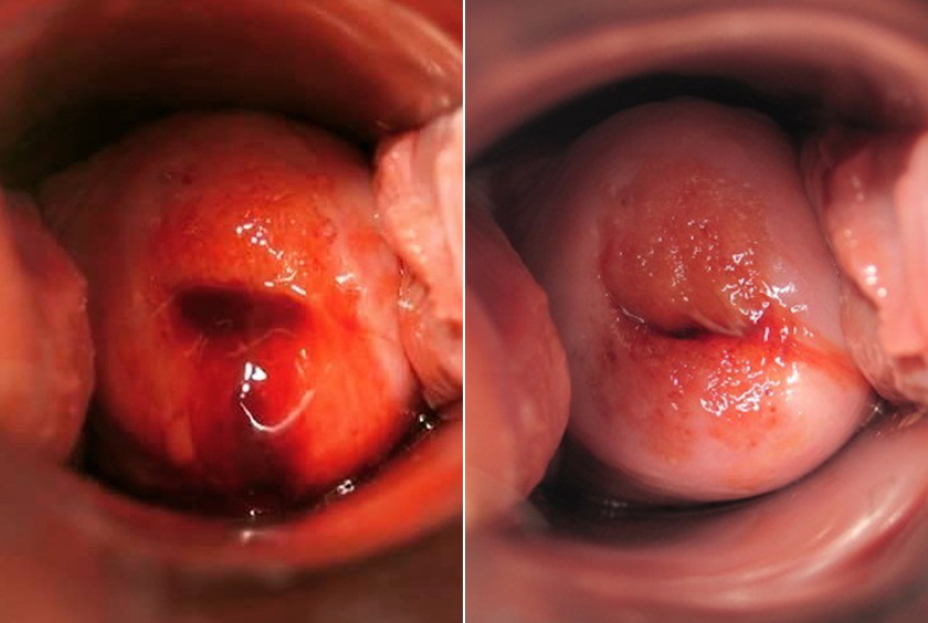 A képen egy 24 éves nő méhnyaka látható a menstruáció második és ötödik napján.