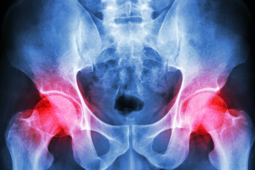 csípőízületi fenékfájdalom a lumbosacralis gerinc osteochondrosisának kezelése