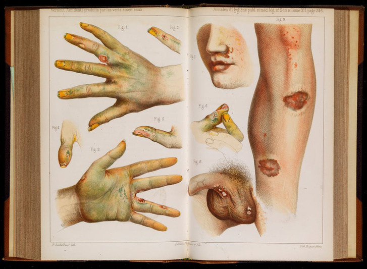A zöldarzénmérgezés tünetei, 1859