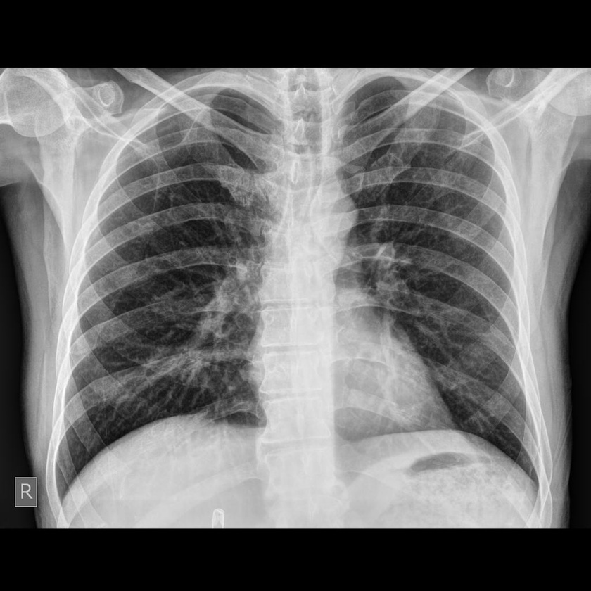 hasi röntgen rák