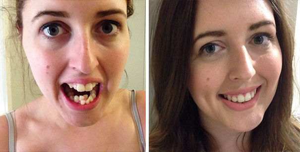 Láthatatlan fogszabályozás fogyás előtt és utáng - Manuela gonzalez a fogyás előtt és utánca