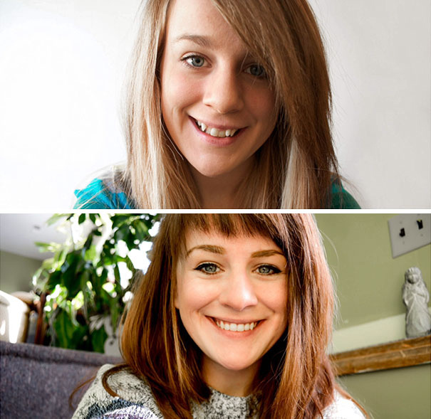 Fogszabályzó előtt és után: ennyit számít a rendezett mosoly - Szépség és divat | Femina