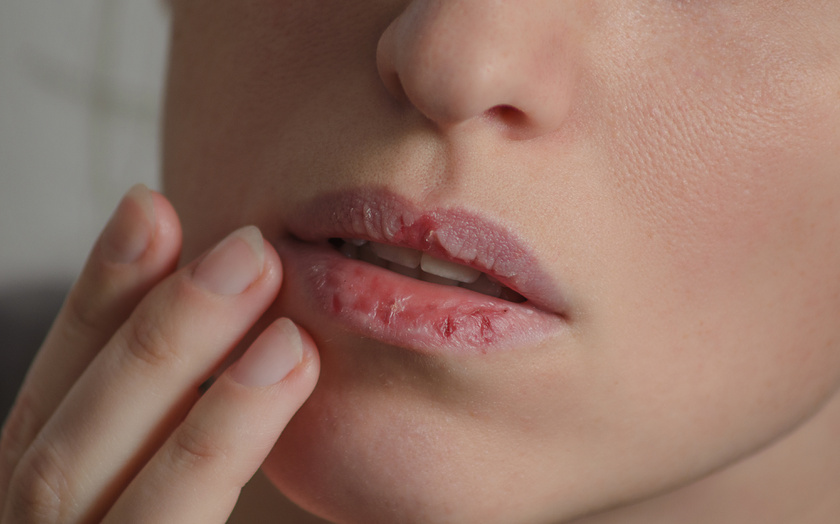 Miért van a száj kellemetlen szaga - 5 betegség, amitől büdös lesz a szája - Dívány