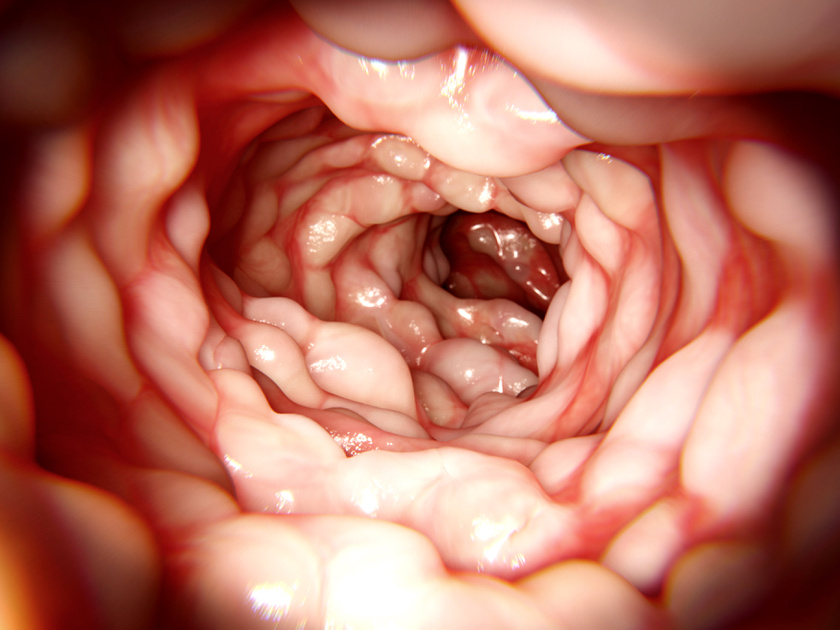 vastagbélpolip tünetei fogyás hogyan lehet fogyni a középháton