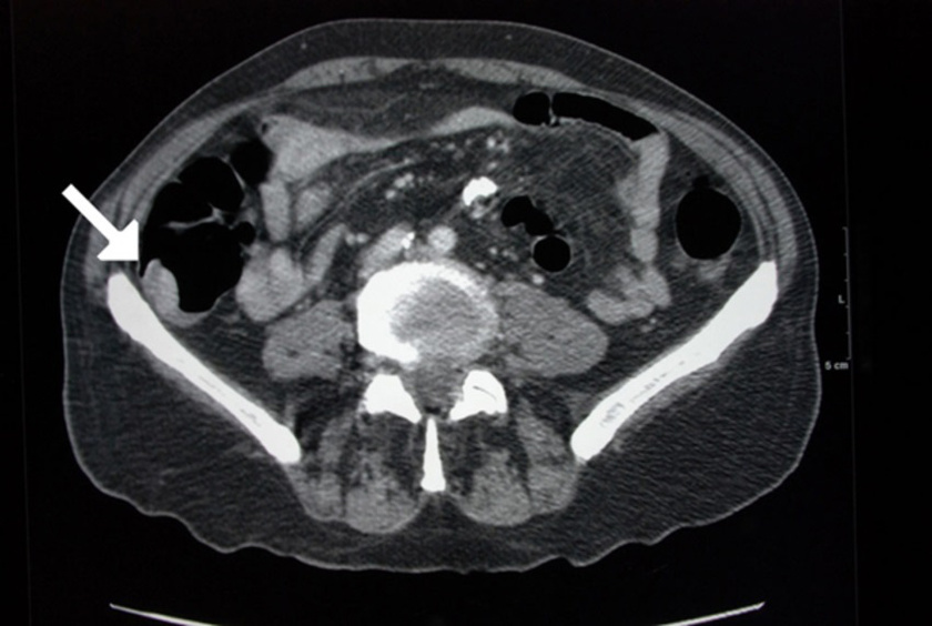 A CT-felvétel a felszálló vastagbélben mutat egy polipot. A nyálkahártya kinövése rákmegelőző állapot, ami leggyakrabban a vastag- és végbélben alakul ki.