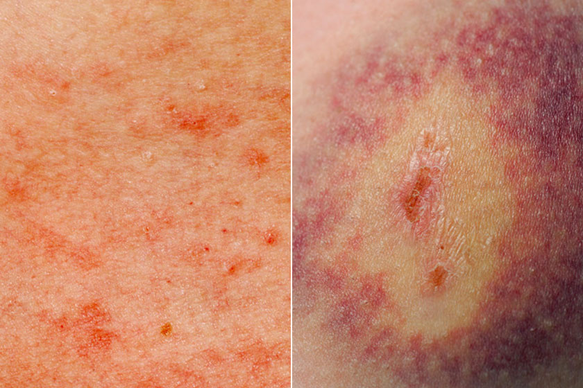 Milyen betegségre utalnak a vörös foltok? Pelyhes vörös foltok a test bőrén