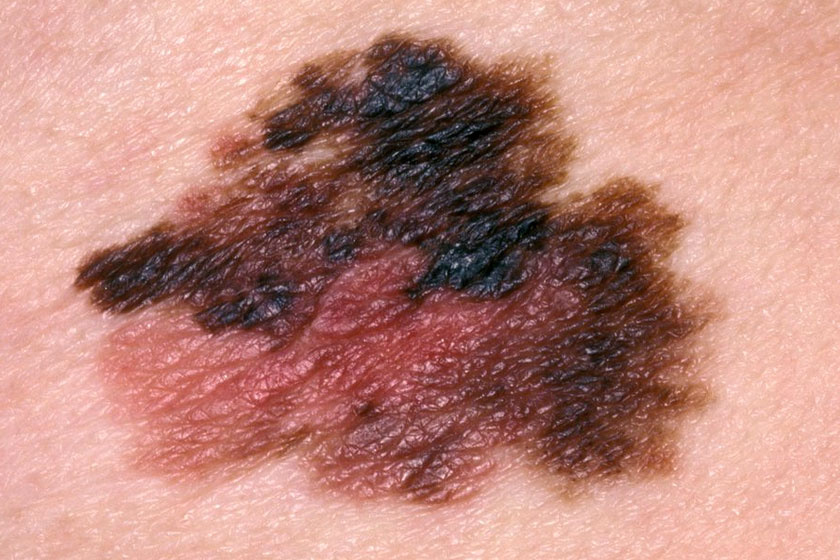 A leggyakoribb bőrrákos elváltozások - Képgaléria - Kerek folt a bőrön, vörös szélekkel