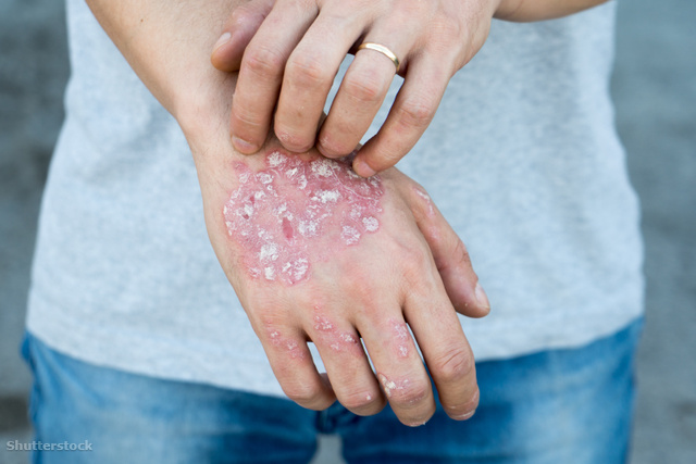 psoriasis skin causes
