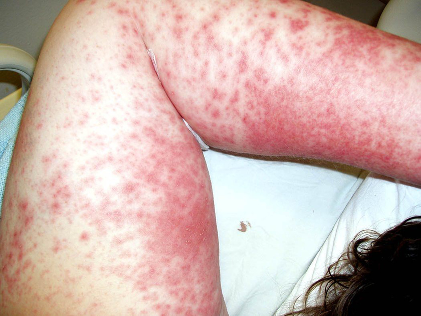 A 7 legbizarrabb bőrbetegség - Megrázó fotókkal! - A test bőrét vörös foltok borítják