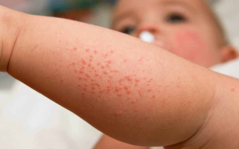 Gyerekkori allergiák - allergiáról mindent egy helyen