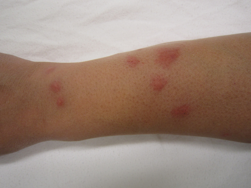 vörös foltok a lábakon otthoni kezelés nem hormon krém pikkelysömörhöz