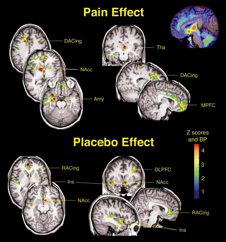 PET és MRI felvétel kombinált kép az agy aktív területeiről, amikor fájdalmat éreznek, illetve miután placebo gyógyszert kaptak. A két felvétel között szignifikáns eltérést tapasztaltak a fájdalom mennyiségét tekintve. A kutatás Jon-Kar Zubieta neurológus készítette 2005. augusztus 23-án, a Michigan Egyetemen