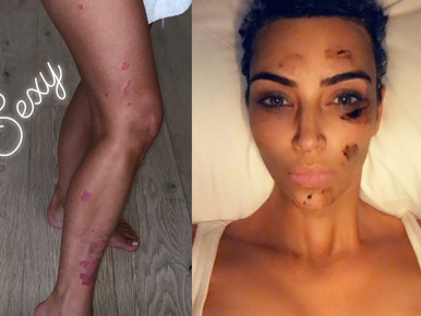 Kim Kardashian megosztotta a pikkelysömörét