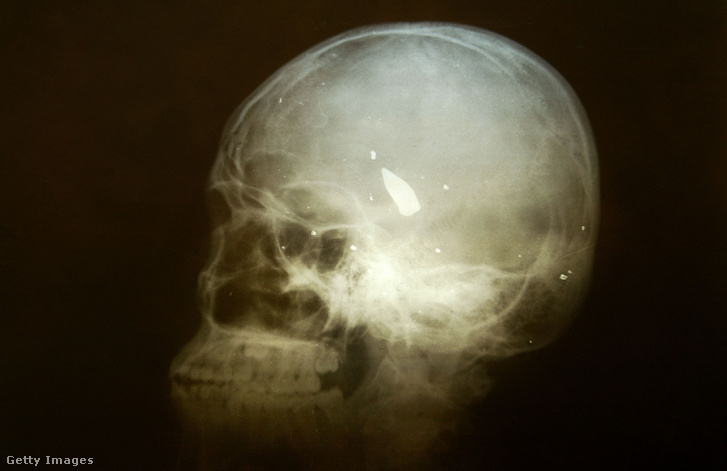 Egy 2003-as koponyaröntgen egy az agy közepébe fúródott lövedékről