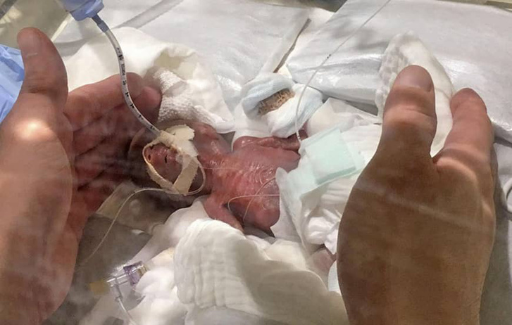 A 268 grammal született baba, 5 nappal a születése után