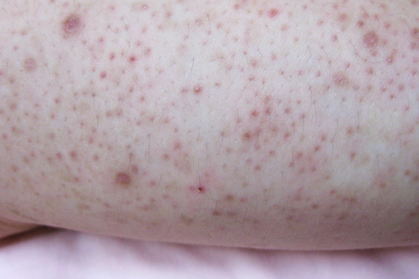 A keratosis pilaris a leggyakoribb bőrproblémák közé tartozik.