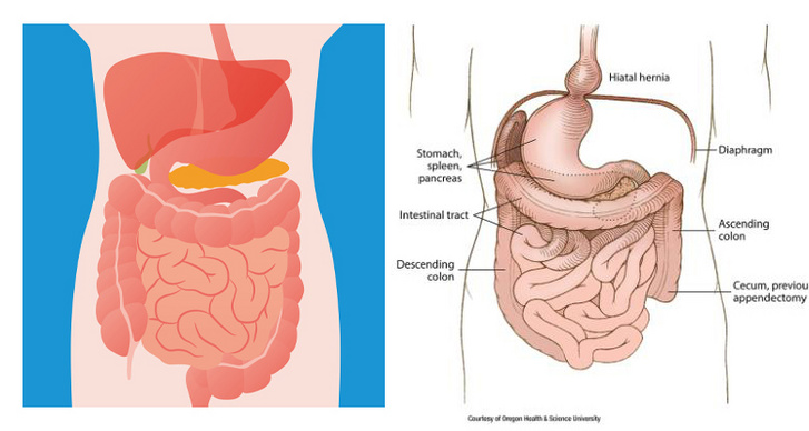 Balra a normális anatómia, jobbra a situs inversus levocardia szervek elrendezése látható