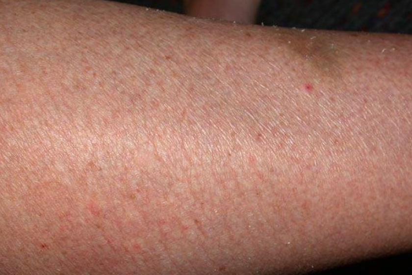 A száraz, viszkető, esetleg érdes tapintású bőr leginkább pajzsmirigy-alulműködés esetén jellemző.
