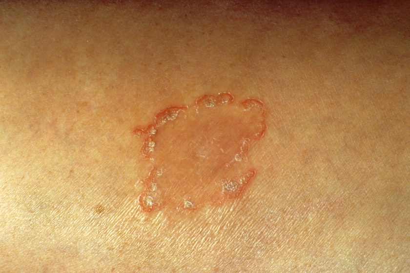 Pityriasis formái - Jellemző bőrtünet a finom hámlás