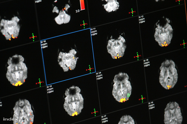 A Semmelweis Egyetem MR Kutatóközpontjában is az agyműködést kutatják