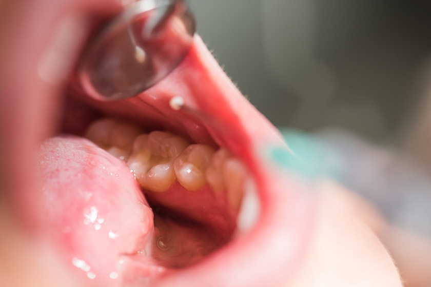 Hip fogak fogyás. Magnézium és a fogyás kapcsolata | Fogyás, Kapcsolatok, Fogak