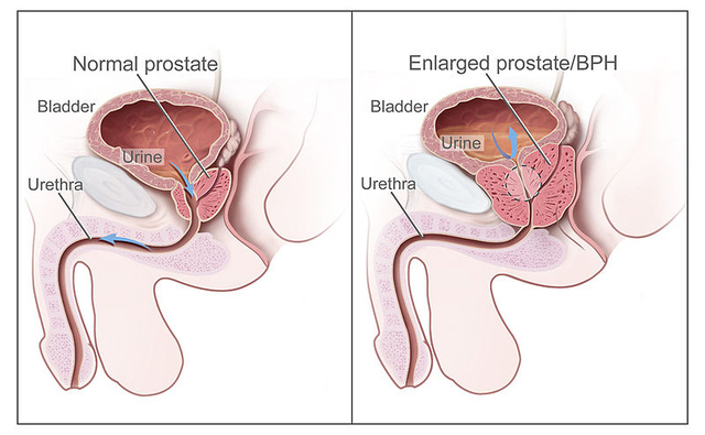 hogyan csökkenthető a prosztata adenoma prostate 18 év