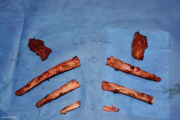 Kristen Snider úgy érezte, hogy esztétikusabb a teste, ha nem tartalmazza ezeket a csontokat.