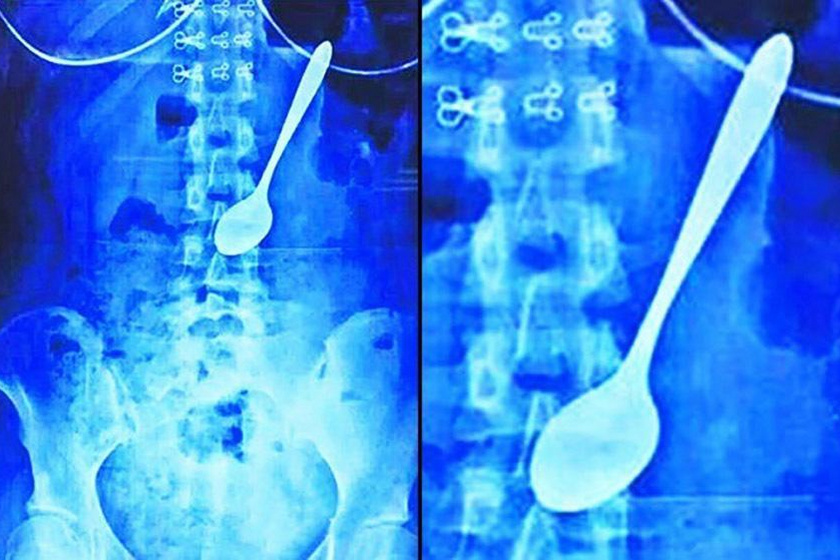 Ez a röntgenfelvétel annak a 22 éves kínai diák gyomráról készült, akit evés közben megijesztett az egyik barátja, ő pedig véletlenül lenyelte a kanalát.
