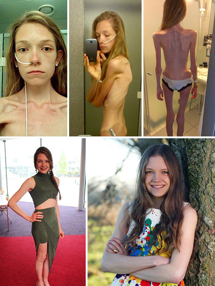 fogyaszthatnak e az anorexiások a gyógyulás után női világ fogyni