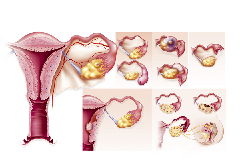endometriózis és a fogyás próbálkozása