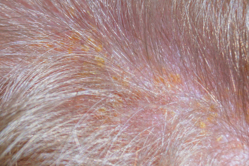 Mikor jelezhet betegséget a viszkető fejbőr?