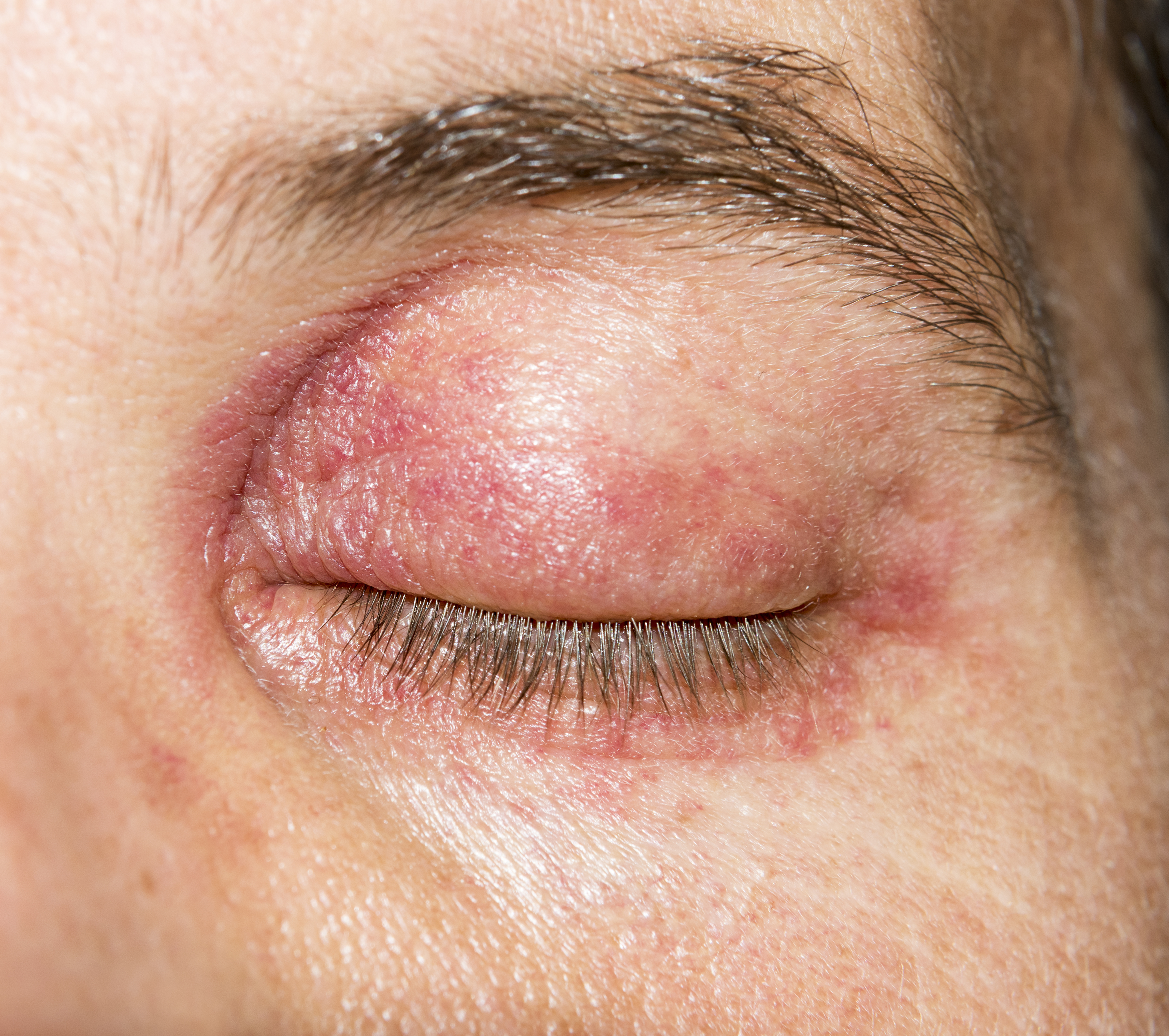 a szem alatt vörös folt hámlik le és duzzad hogyan lehet hatékonyan gyógyítani a pikkelysömör fején