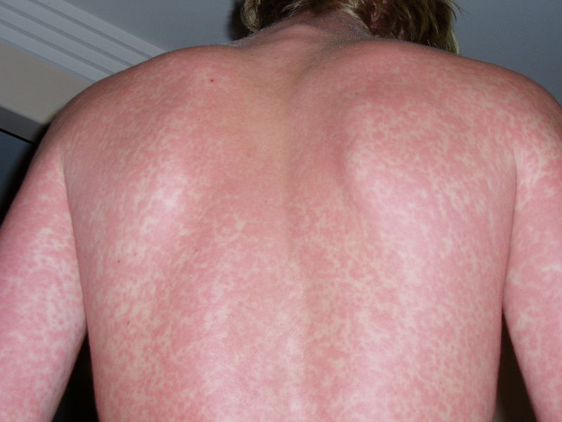 Az allergiavizsgálat menete – a bejelentkezéstől a diagnózisig