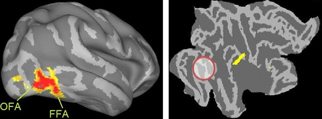 Az fMRI-s kísérletben azarcfeldolgozás korai, perceptuális szakaszában az OFA-ban és FFA-ban kontroll személyeknél az arcképekre magasabb aktivitást láthatunk (bal oldali ábrán a piros folt), mint zajosított képeknél. Ugyanez a mintázat a 3 arcvak kísérleti személynél nincs meg (jobb).