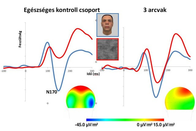 EEG kísérletben az egészséges emberekben az N170 arcoknál (kék vonal) nagyobb, mint zajos ábráknál (piros). A különbség a jobb féltekén a legnagyobb, de arcvakoknál jóval kisebb mértékű, amiből látszik az arcfeldolgozásban részt vevő idegrendszeri folyamatok károsodása.