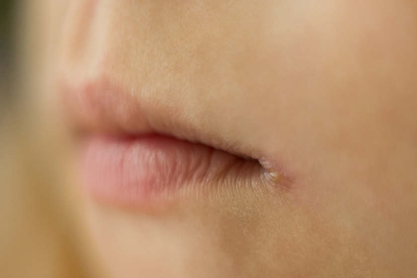 Hogyan lehet zsírégetni a szája körül