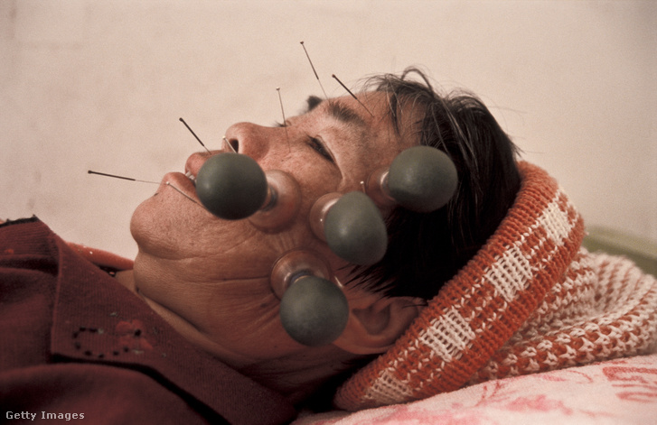 Egy nő arcán alkamaznak hagyományos kínai orvoslást, a köpölyözést és az akupunktúrát