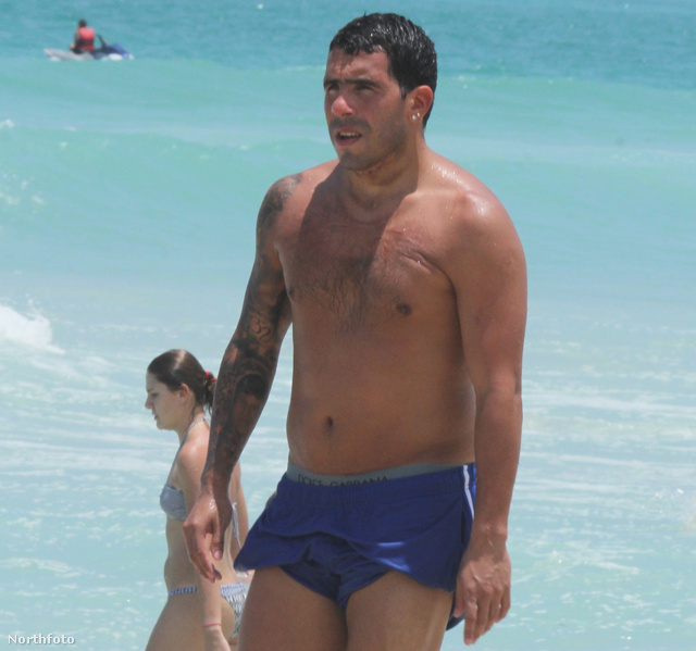 Carlos Tevez égési sérülései még mindig látszanak