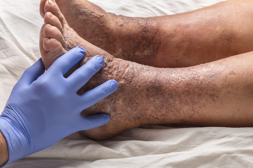 viszkető lábszár stasis dermatitis