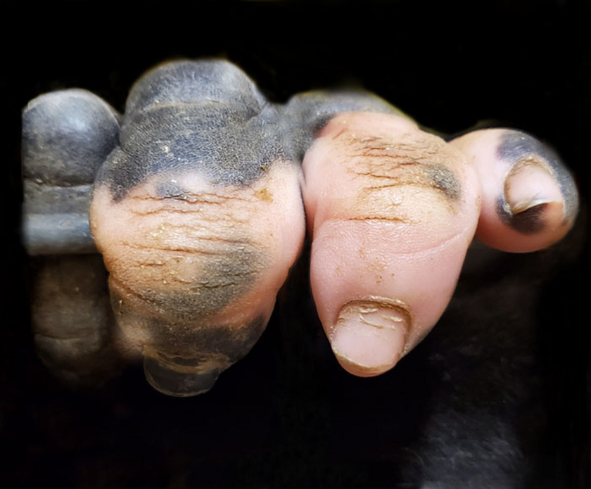 Így néz ki Anaka keze közelről. Sokan feltételezték, hogy bőre talán a pigmentvesztéssel járó betegség, a vitiligo miatt ilyen.