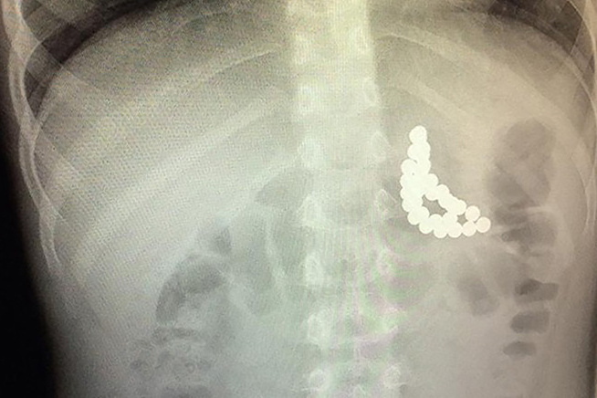 Mágneses gyöngyök a 3 éves kisfiú röntgenképén