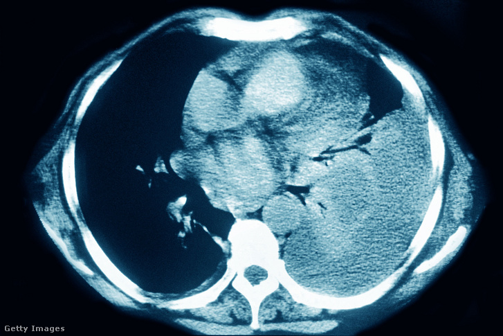 Mellhártyagyulladás egy tüdő-CT-n