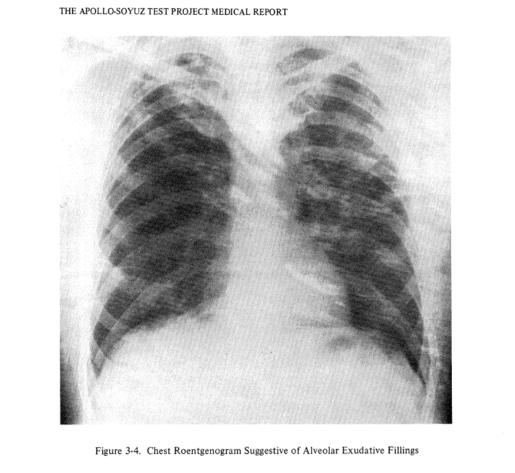 Az egyik űrhajós tüdővizenyőről árulkodó mellkasi röntgenfelvétele a kórházi kezelésről szóló jelentésben