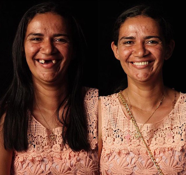 A 28 éves nő arca teljesen megváltozott az új fogsortól. Az orvos hozzátette, a szép mosoly az emberek társadalmi beilleszkedését is nagyban elősegíti.